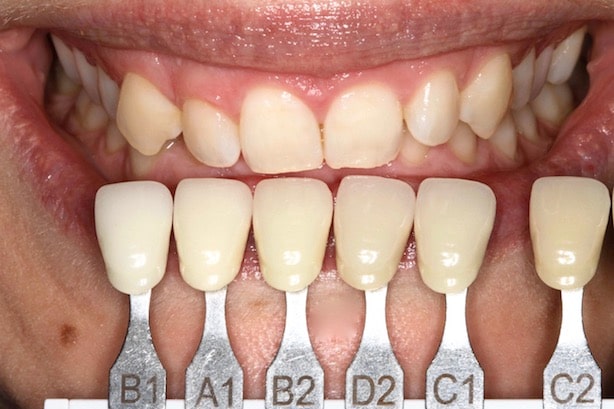 Elleven-Dental-Enlighten