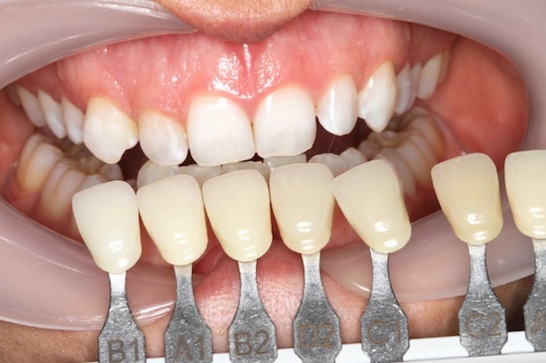 Elleven-Dental-Enlighten
